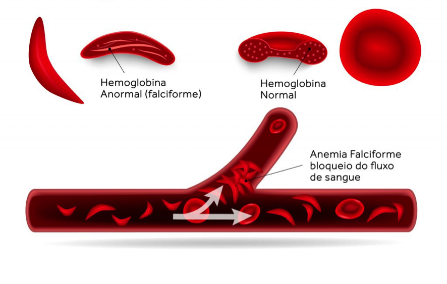 A Eletroforese de Hemoglobina no diagnóstico de Anemia Falciforme