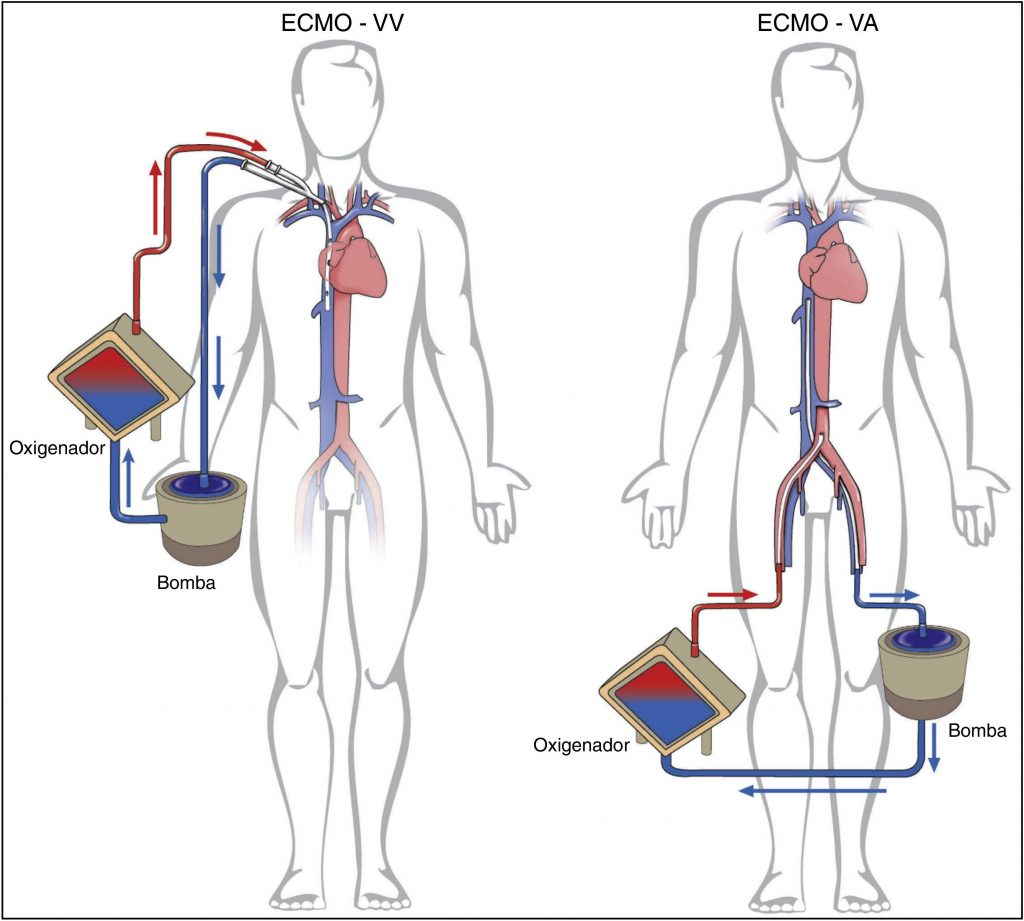 ECMO o que é, tipos e aplicações AGD Cursos