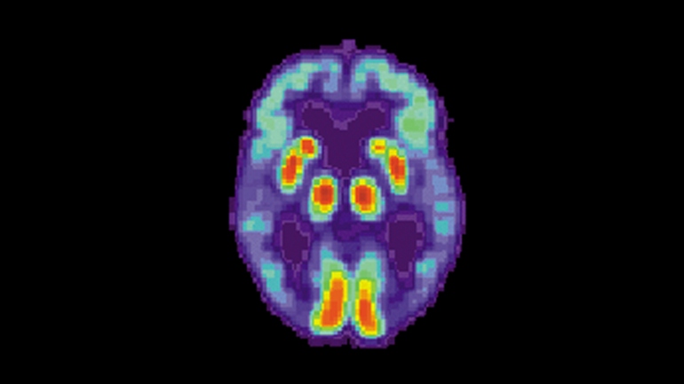 Análise de imagens de PET/CT detecta Alzheimer seis anos antes do diagnóstico